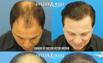 Top view - Before and after surgical hair replacement