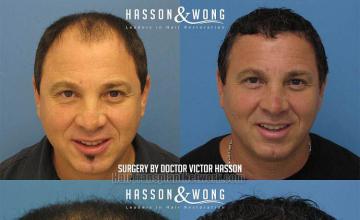 Hair transplant surgery before and after pictures