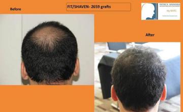 Hair transplantation surgery before and after pictures