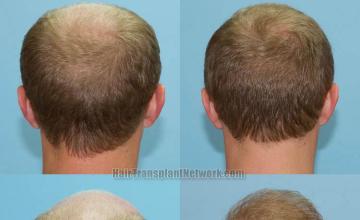 Surgical hair transplantation result photographs