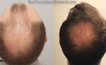 Surgical hair transplantation result photographs