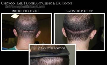 Hair restoration procedure before and after pictures