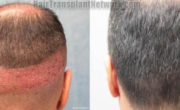 Hair transplantation procedure before and after photographs