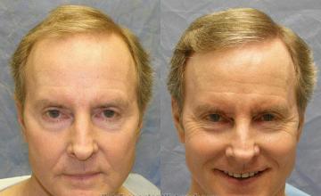 Before and after  photos