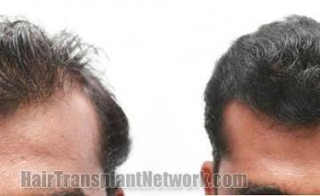 Before and after surgical hair replacement procedure
