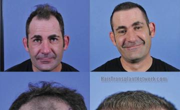 Hair restoration procedure before and after results