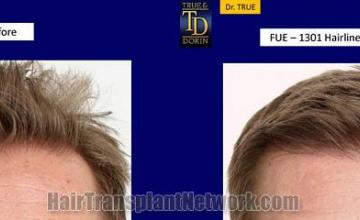 Before and after hair transplant procedure images