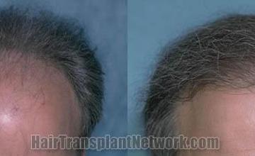 Hair transplantation surgery before and after images