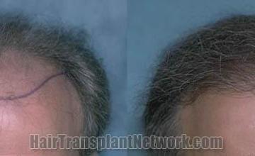 Hair transplantation surgery before and after pictures