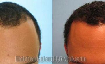 Hair restoration procedure before and after results