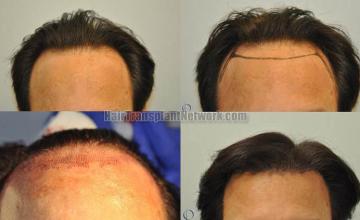 Hair transplantation surgery before and after photos