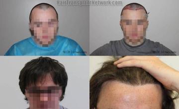 Hair restoration procedure before and after results