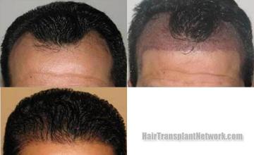 Before and after hair transplantation result photographs