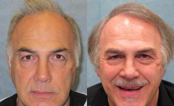 Hair transplantation surgery before and after pictures
