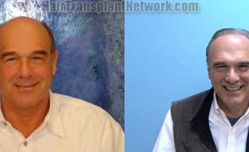 Hair transplantation surgery before and after images