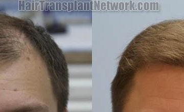 Front view - Before and after  