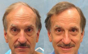 Front view - Before and after hair transplantation surgery