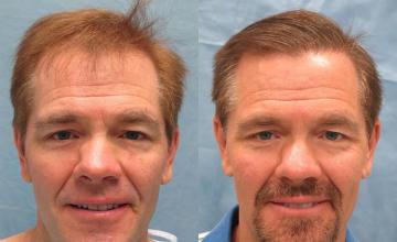 Hair transplantation surgery before and after photos