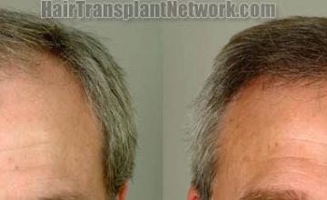 Front view - Before and after