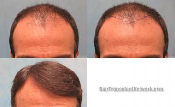 Front view - Before and after hair transplantation surgery