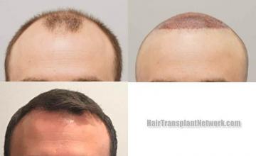 Front view - Before and after hair restoration procedure