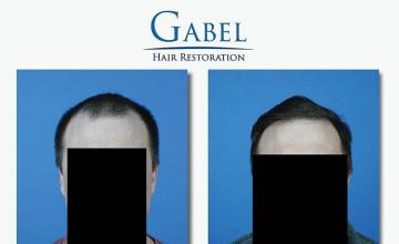 Front view - Before and after