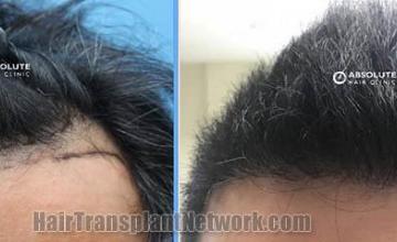 Front view - Before and after hair restoration procedure