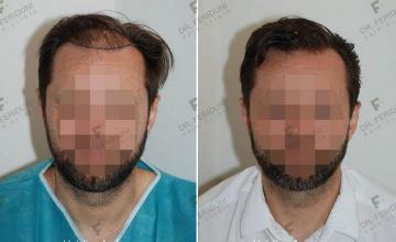 Front view - Before and after