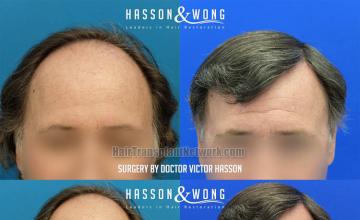 Front view - Before and after