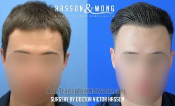 Front view - Before and after hair restoration procedure