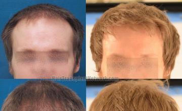 Hair restoration procedure before and after results