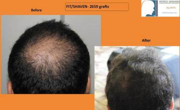 Hair restoration procedure before and after pictures