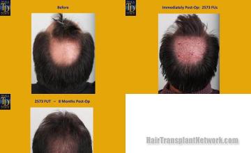 Hair restoration procedure before and after pictures