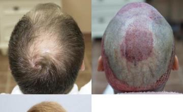 Hair restoration procedure before and after pictures