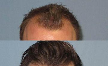 Hair transplantation surgery before and after images