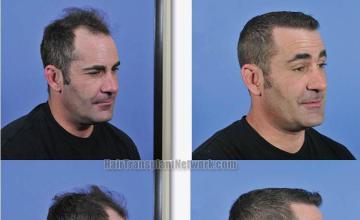 Hair transplantation surgery before and after images