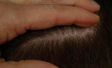 Residual hair transplant donor scar images