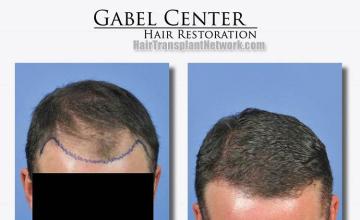 Hair transplantation surgery before and after pictures