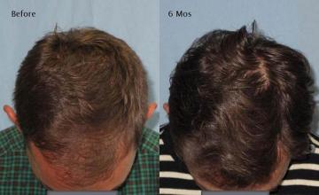 Hair transplantation surgery before and after photos