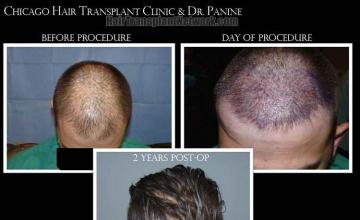 Top view before and after hair restoration results