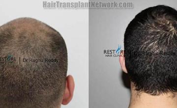 Hair transplantation surgery before and after pictures