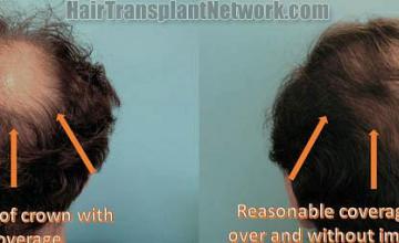 Hair restoration procedure before and after pictures