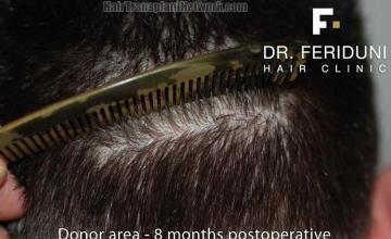 Hair restoration surgery before and after photos