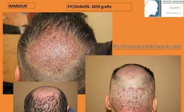 Hair restoration surgery before and after photos