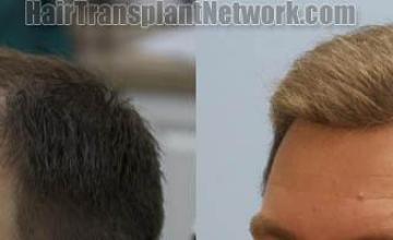  before and after photos