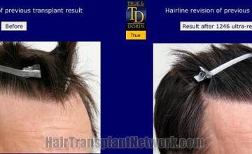 Hair restoration procedure before and after pictures