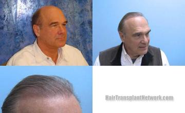 Hair restoration procedure before and after pictures