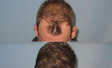 Hair restoration procedure before pictures