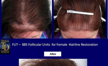 Hair transplantation surgery before and after photos