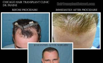 Before and after hair transplant procedure images